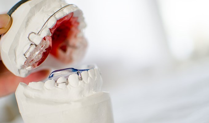 Röd tandställning sitter fast på en modell gjord av gips