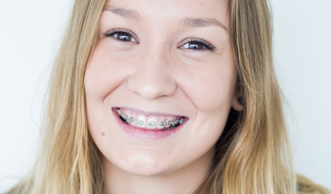 Brunögd, leende, ung tjej med tandställning