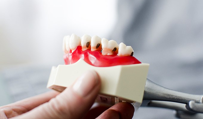 Tandavgjutning med tandställning